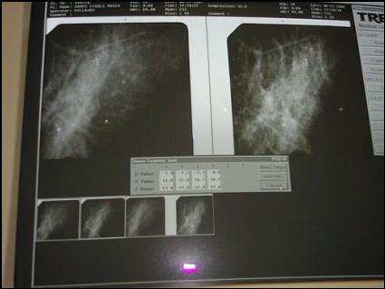 Imatge sistema de calcul biòpsia mamària