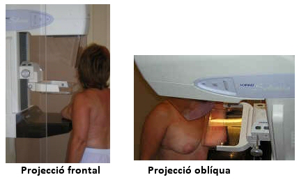 Imatge: com es fa una mamografia; projecció frontal i projecció oblíqua