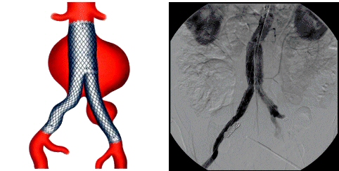 Image. Endoluminal treatment of aortic aneurysms. URVI (UDIAT)