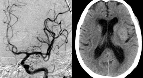 Example. Mechanical rescue thrombectomy in ischemic stroke
