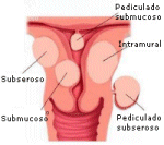 Imaging of a uterine myoma