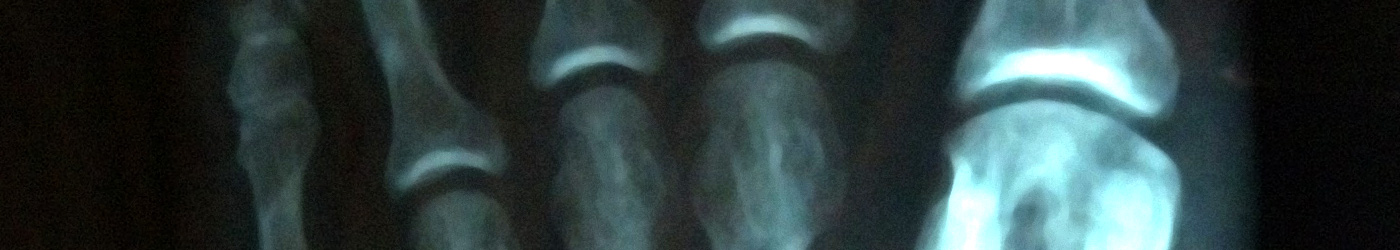 Imagen de la radiografía de la parte de los dedos del pie