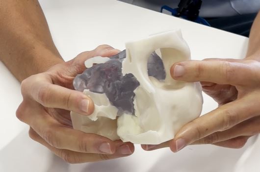 Èxit de la primera cirurgia transorbital, per extreure tumors de la base del crani a través de l’ull