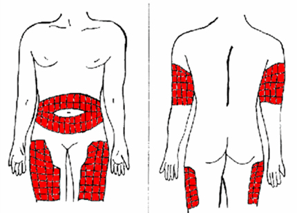 Imagen del cuerpo humano con zonas marcadas en rojo idóneas para pinchar la EPO