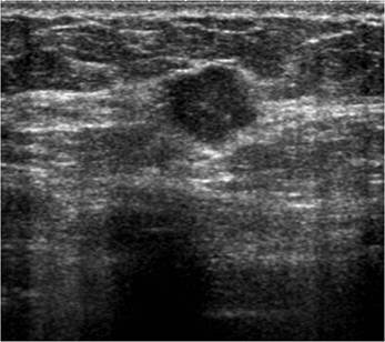 Marcatge pre-quirúrgic guiat per ultrasons. Unitat Radiologia Mamà ria. UDIAT. Parc TaulÃ