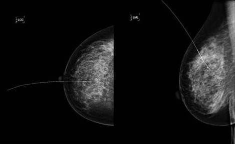 Marcatge pre-quirúrgic guiat per ultrasons