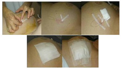 Marcatge pre quirúrgic guiat per ultrasons