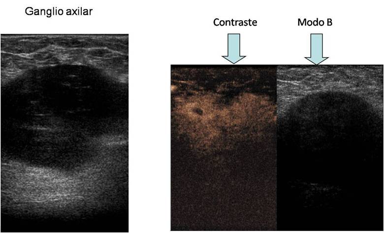 Imatge de ganglis axilars amb l'ecografia de mama amb contrast. Radiologia Mamà ria. UDIAT. Parc TaulÃ