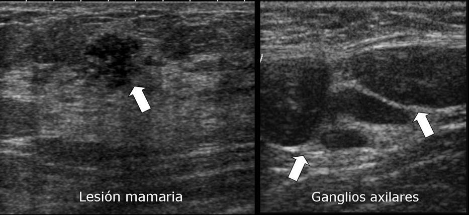 Imatge d'una lesió mamà ria i els ganglis axiliars en l'ecografia de mama amb contrast. UDIAT. Radiologia Mamà ria