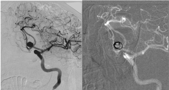 Example image. Brain aneurysm embolization with balloon remodeling technique