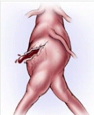 Imagen. Rotura aneurisma. URVI (UDIAT)